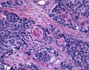 pancreatoblastoma